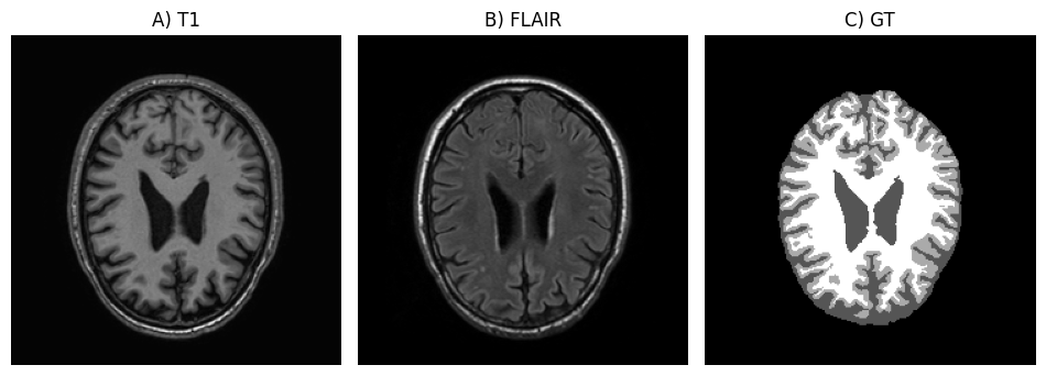 Image for Unsupervised Brain Tissue Segmentation with GMM and EM