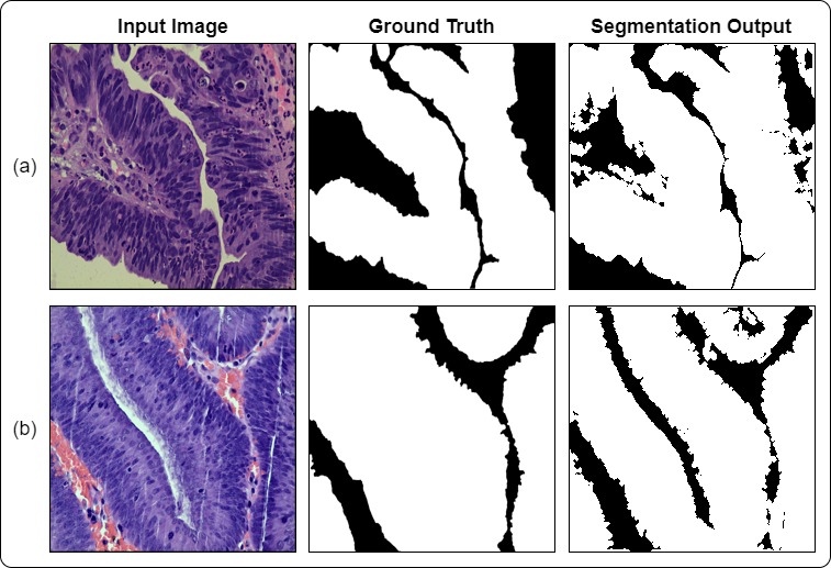 Image for Multi-class Classification and Gland Segmentation of Colorectal Cancer Tissues from Histopathology Images
